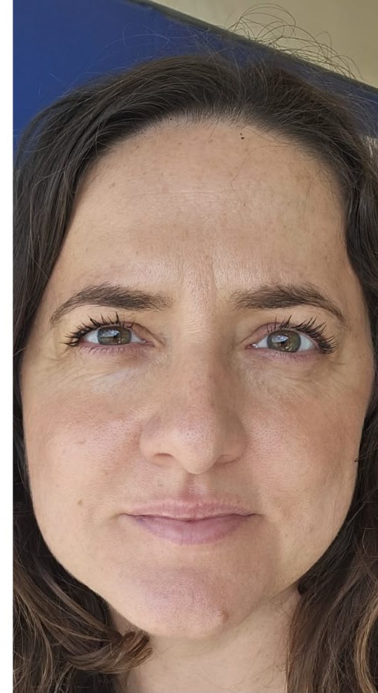 תוצאת טיפול אמיתית של מטופלת 6, אחרי
