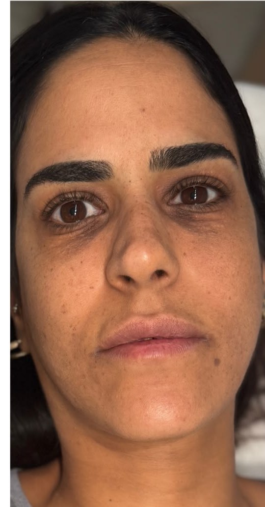 תוצאת טיפול אמיתית של מטופלת 4, אחרי