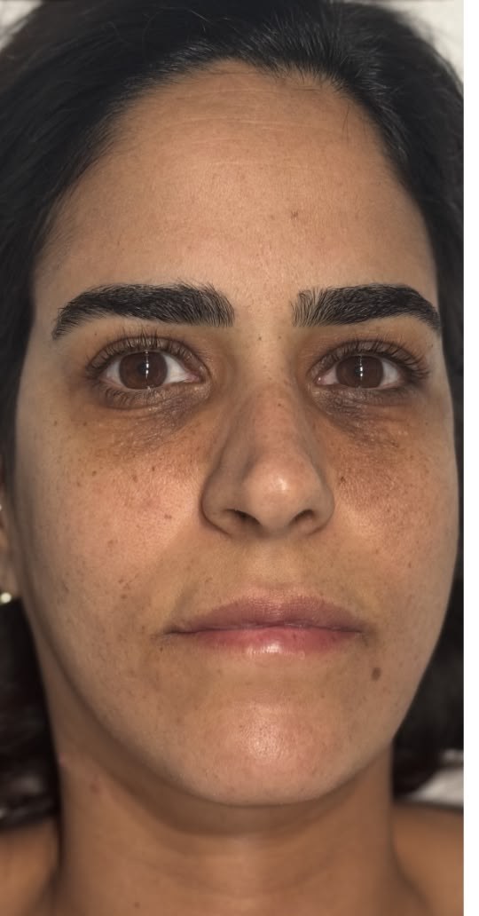 תוצאת טיפול אמיתית של מטופלת 4, לפני